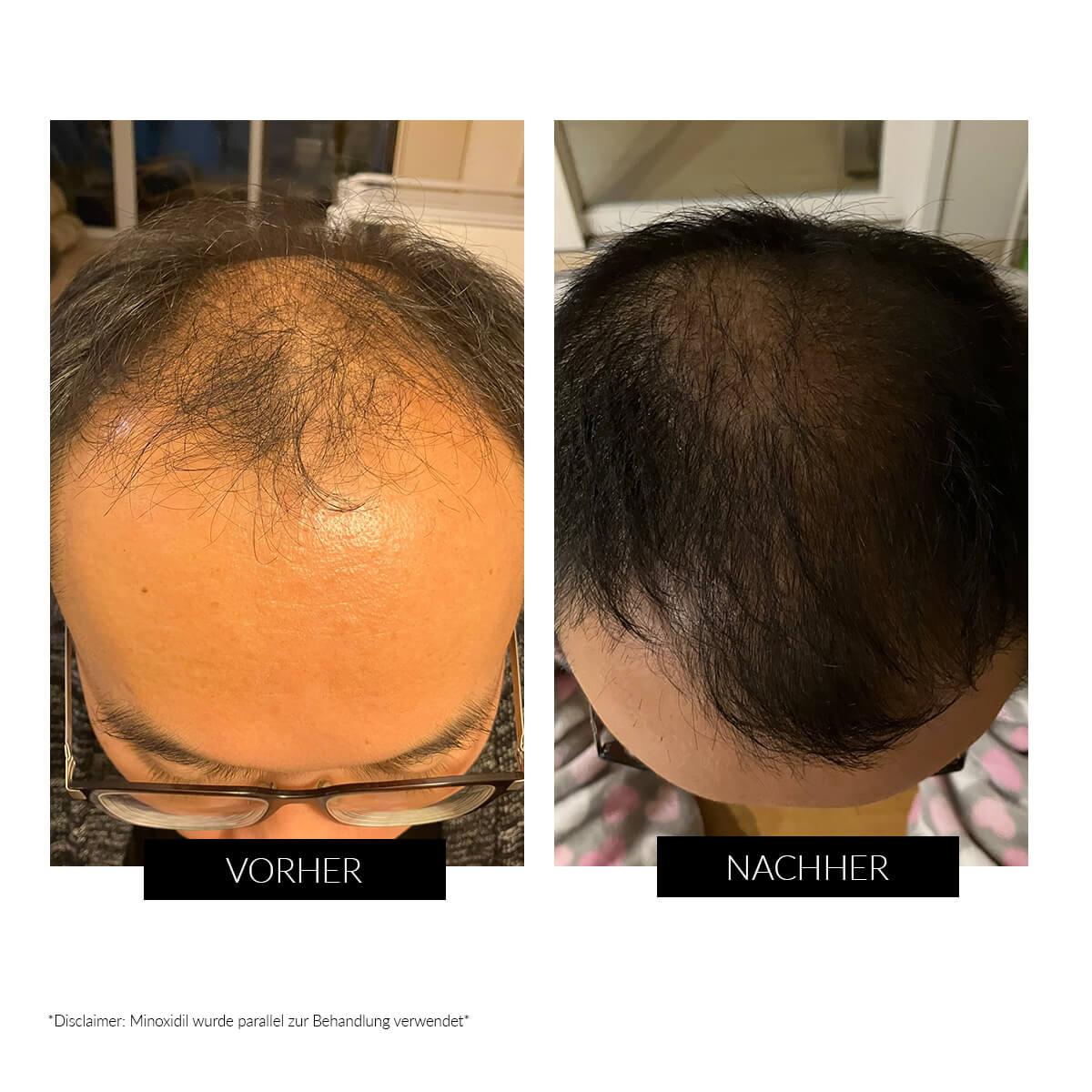 CurrentBody Skin LED Gerät gegen Haarausfall